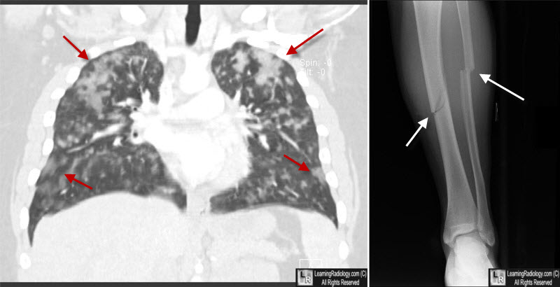 Fat Embolism